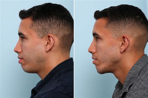 Male Cosmetic Surgery Photos Houston Tx Patient 58004