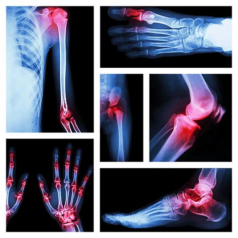 Bone And Joint Injuries In Football Football4football