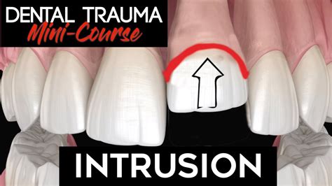 Dental Trauma Mini Course Part 8 Dental Trauma Guide Intrusion