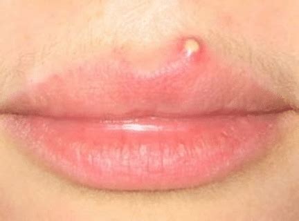 White Spots On Lips Fordyce Spots Small Inside Of Sides Pictures