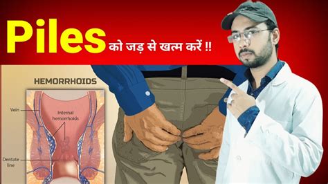 बवासीर Piles को जड़ से खत्म करें Piles Treatment At Home In Hindi