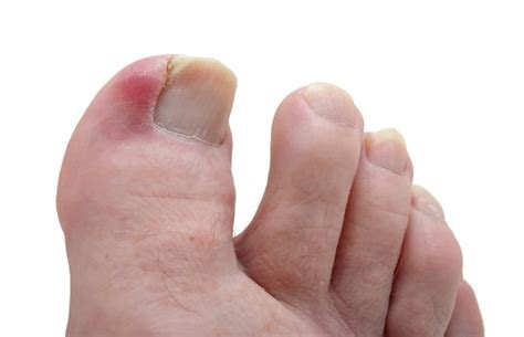 How To Spot Diabetic Foot Complications Early Health24