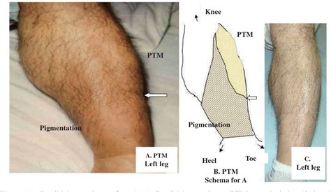 Figure 1 From Treatment Of Pretibial Myxedema Ptm With Topical