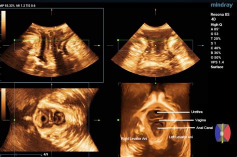 Ultrasound Journal 2 The Levator Trauma In Childbirth Mindray
