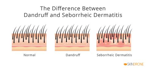 Seborrheic Dermatitis On The Scalp The Complete Guide Skindrone