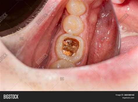 Dental Caries Filling Image And Photo Free Trial Bigstock