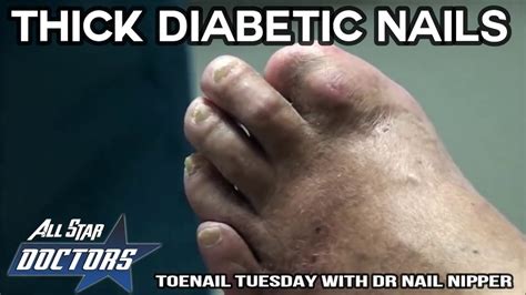 Thickest Diabetic Nails All Star Nail Clipping Youtube