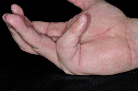 Dupuytrens Contracture Photograph By Dr P Marazziscience Photo Library