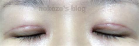 手術後10日後目元の保湿 - 元美容整形外科カウンセラーによる ...