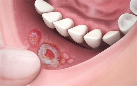 Las aftas o úlceras bucales causas síntomas y prevención Clínica