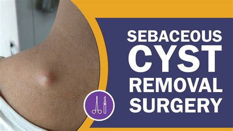 Sebaceous Cyst Removal Surgery What You Need To Know Dr PK Talwar