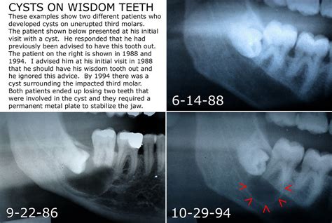Cysts On Wisdom Teeth Please Read The Text In The Image Fo Flickr