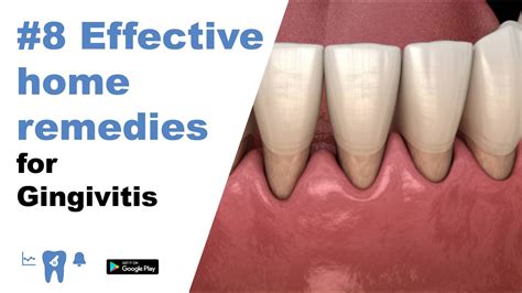 8 Effective Home Remedies For Gingivitis Youtube