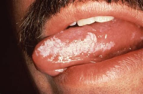 Tongue Blisters Causes Red White Small Painful And Cures American
