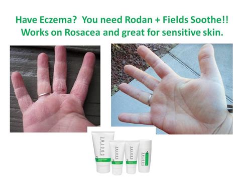 Have Eczema Rosacea Or Sensitive Skinyou Need Rodan Fields