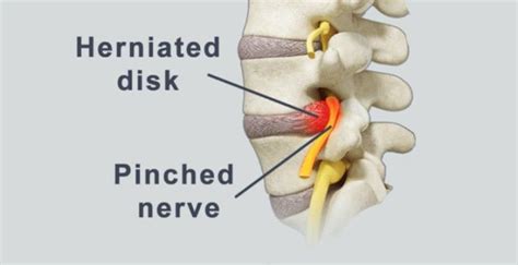 How To Get Rid Of That Pinched Nerve In Your Hip Clarendon Chiropractic