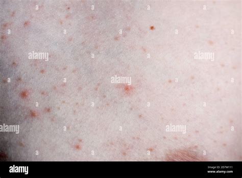 Morbilli High Resolution Stock Photography And Images Alamy