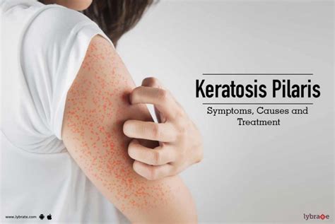 Keratosis Pilaris Symptoms Causes And Treatment Skinology
