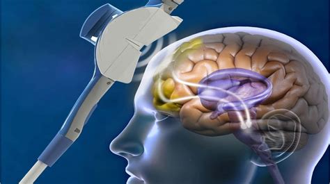 Транскраниальная магнитная стимуляция мозга что это такое и как используется в терапии