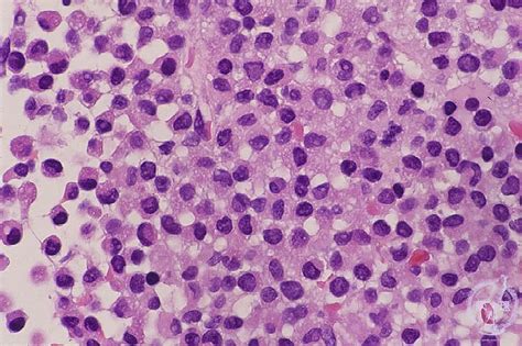 1bone Marrow Hematopoietic System 5 Acute Myeloid Leukemiam3
