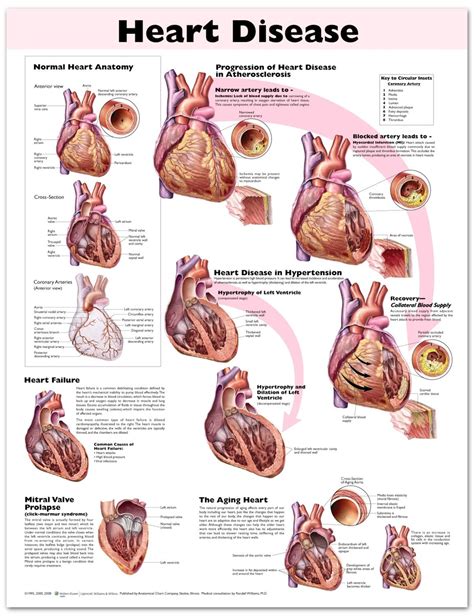 Heart Disease Chart Poster Laminated Heart Anatomy Heart Disease