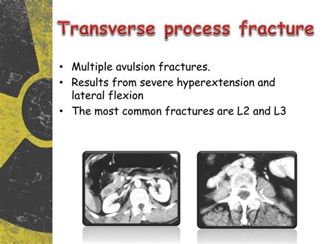 T1 Transverse Process Fracture