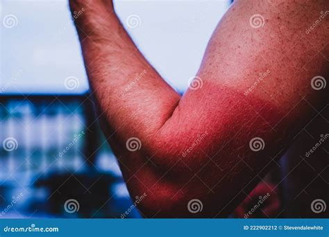 Arm With Visible Red Sunburn Caused By Wearing A Shirt Stock Photo