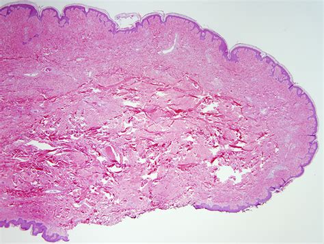 Pseudosarcomatous Polyp Dermatopathology