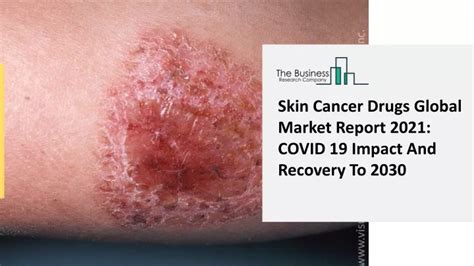 Ppt 2021 Skin Cancer Drugs Market Share Restraints Segments And