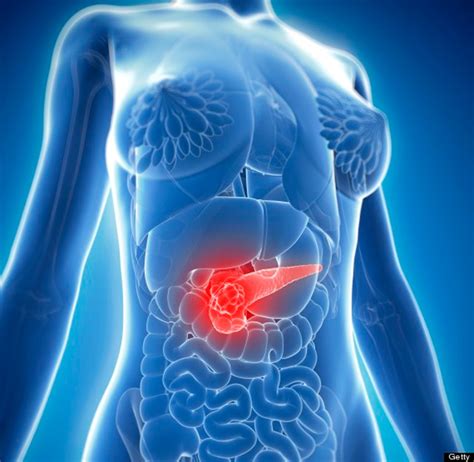 Pancreatic Cancers Could Be Prevented By Lifestyle Changes