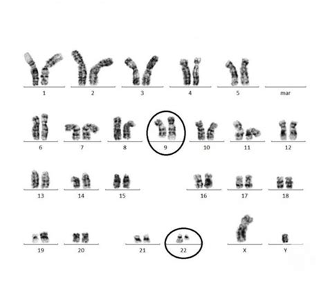 Understanding The Bcr Abl Translocation The Philadelphia Chromosome