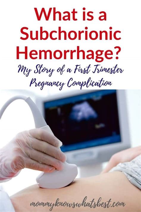 Subchorionic Hemorrhage Bleeding In First Trimester Story