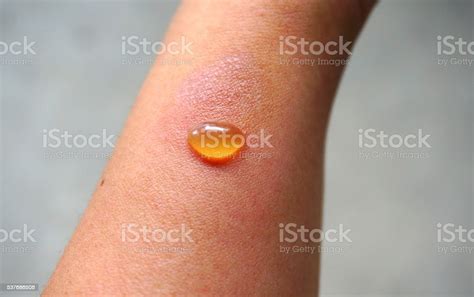 Blister On Skin Stock Photo Download Image Now Alternative Therapy