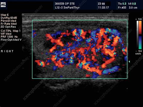 Inflamed Lymph Node Doppler Ultrasound Stock Image M2000176