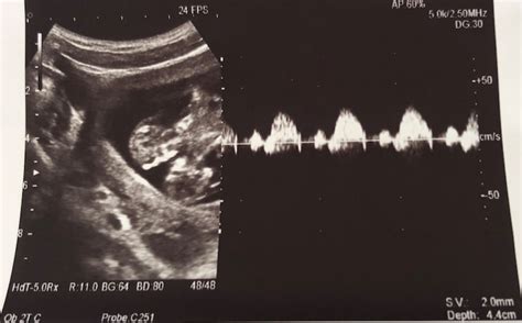 無料ダウンロード 24 Weeks Pregnant With Twins Ultrasound 485923 24 Weeks