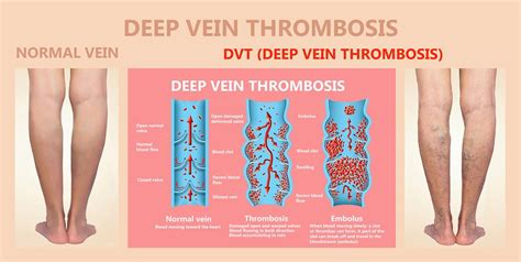 Blood Clot In Leg During Pregnancy Symptoms Pregnancywalls