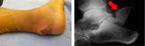 Calcaneus Fracture Broken Heel Bone Orthopaedic Trauma Association