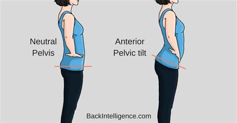 How To Fix Anterior Pelvic Tilt Posture 10 Exercises Pelvic Tilt