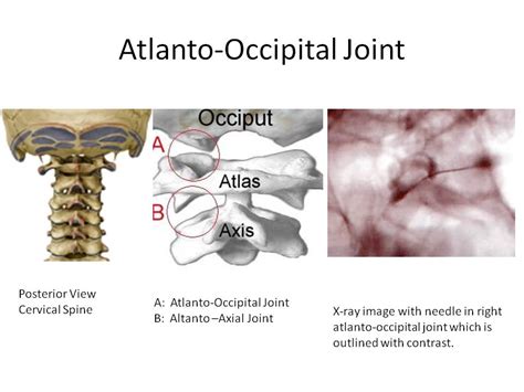 Headaches Arising From Atlanto Occipital Joint Csc