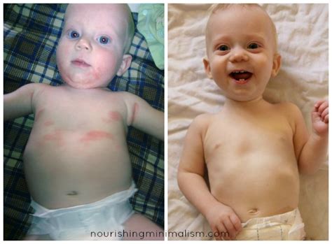 Using extreme minimalism to highlight what your minimalist lifestyle could look like. How I Cured My Infant's Eczema - Nourishing Minimalism
