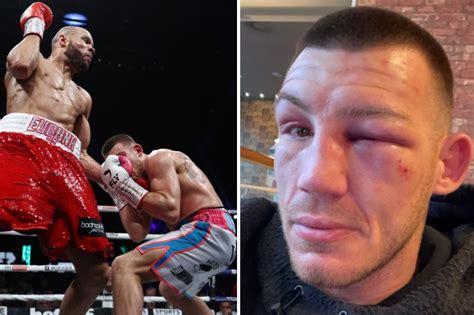 Liam Williams Shows Off Brutal Eye Injury And Battered Face After Chris