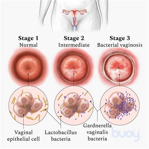 Decoding Bacterial Vaginosis Bv Causes Symptoms Treatment And