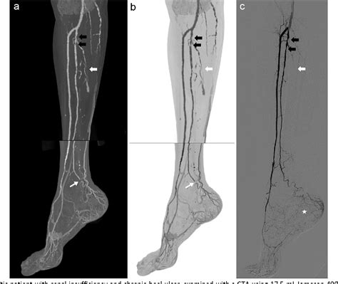 Figure 2 From Selective Intra Arterial Dual Energy Ct Angiography S