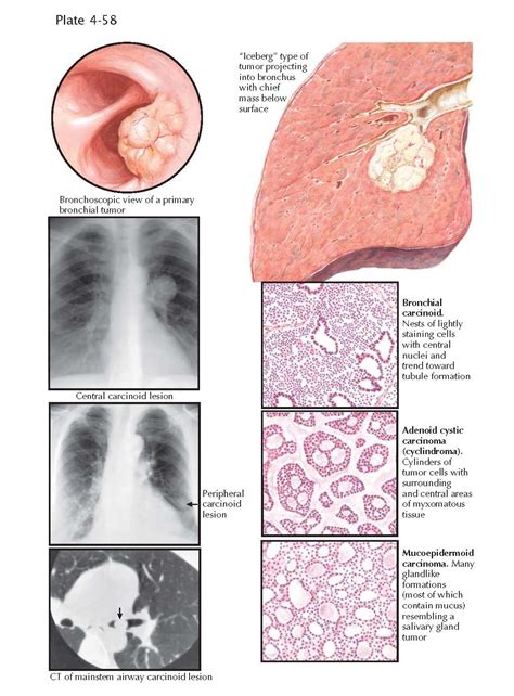 Other Neoplasms Of The Lung Pediagenosis