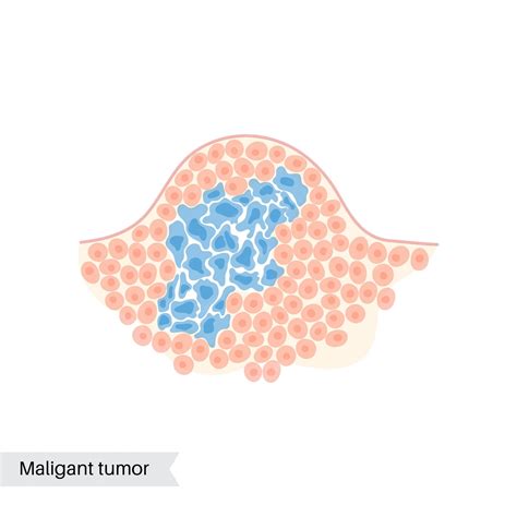 Vector Ilustración Aislada De Tumor Maligno En Tejido Sano Propagación