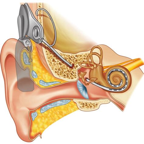 Cochlear Implant Fig Cochlear Implant Internal And External