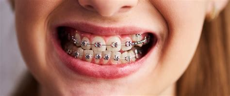 Dentofacial Orthopedics Smilelineorthodontics