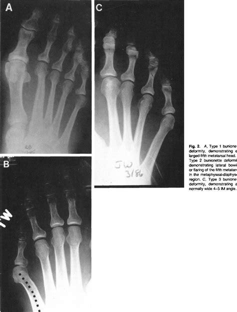 Figure 2 From Treatment Of Bunionette Deformity With Longitudinal
