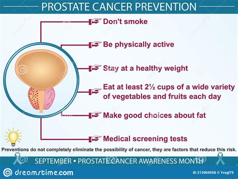 Prostate Cancer Prevention Infographic Vector Illustration Stock Vector Illustration Of