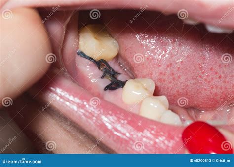 Stitches After Dental Extraction Royalty Free Stock Photo